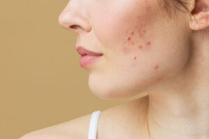  How To Reduce Heat Pimples