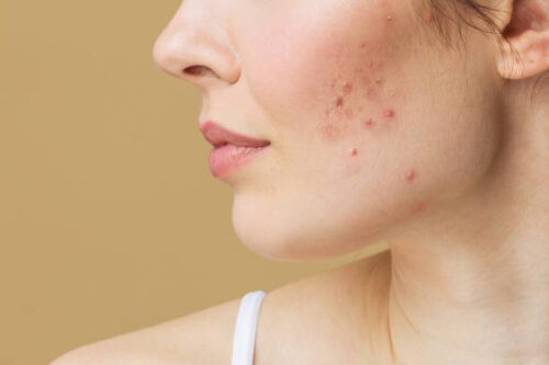 Understanding Pimples