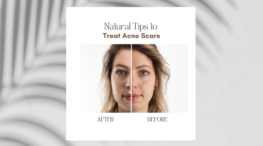 Natural Tips to Treat Acne Scars